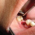 Recovering from Oral Surgery: What You Need to Know