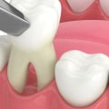 What to Do if You Experience Pain or Discomfort After Oral Surgery