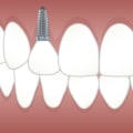 Restore Your Smile with Dental Implant Surgery in North Little Rock