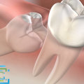 What Medications Should be Avoided After Oral Surgery?