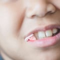 What Activities Should be Avoided After Oral Surgery?