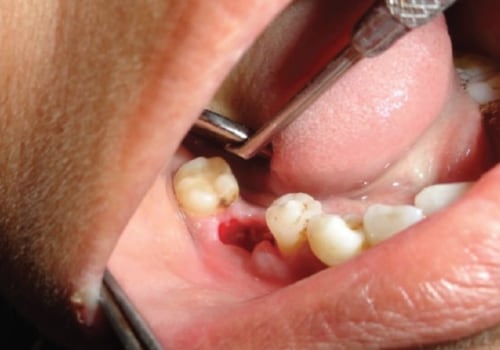 Recovering from Oral Surgery: What You Need to Know