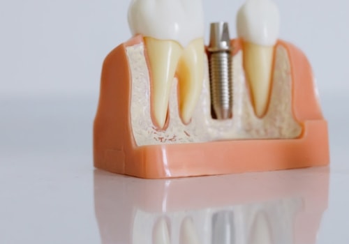 How A Bridge Dentist In Manassas Park, VA, Can Transform Your Smile With Oral Surgery