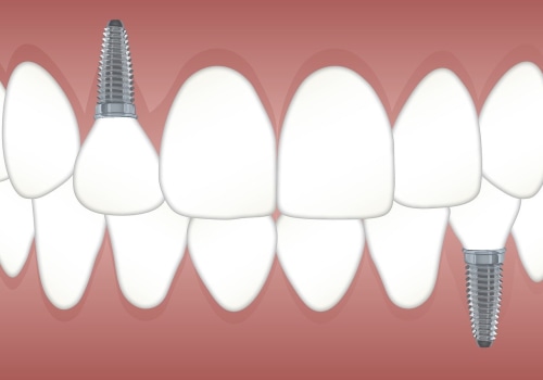 Restore Your Smile with Dental Implant Surgery in North Little Rock