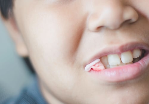 What Activities Should be Avoided After Oral Surgery?
