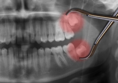 The Most Common Types of Oral Surgery